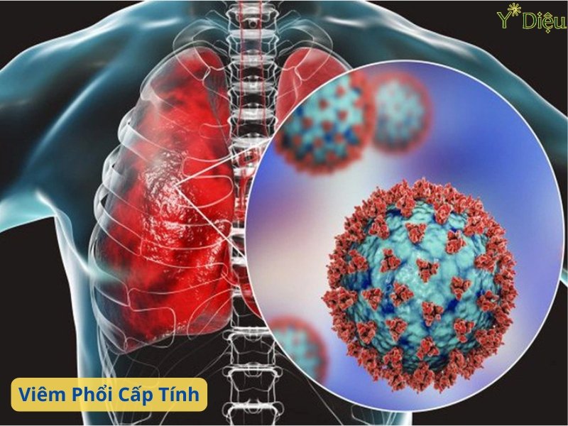 Viêm phổi cấp tính: Triệu chứng, nguyên nhân, cách điều trị